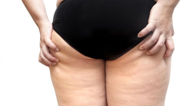 Cellulite
