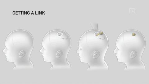 Image tirée d'une vidéo de diffusion en direct de Neuralink montrant un schéma des différentes étapes de l'implantation d'un dispositif Neuralink, lors d'une conférence le 28 août 2020 à San Francisco, en Californie