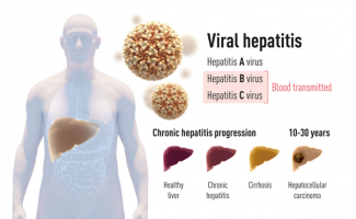 Viral hepatitis